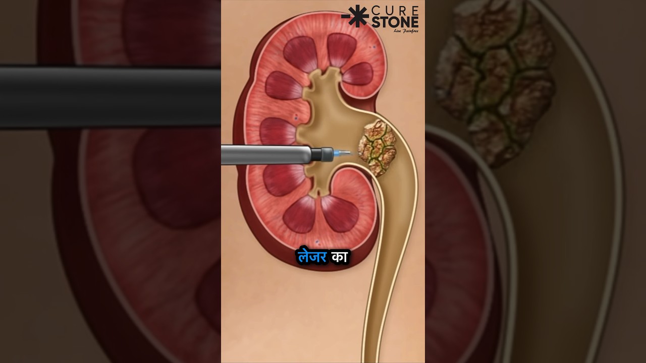 Kidney stone treatment | PCNL | #shorts