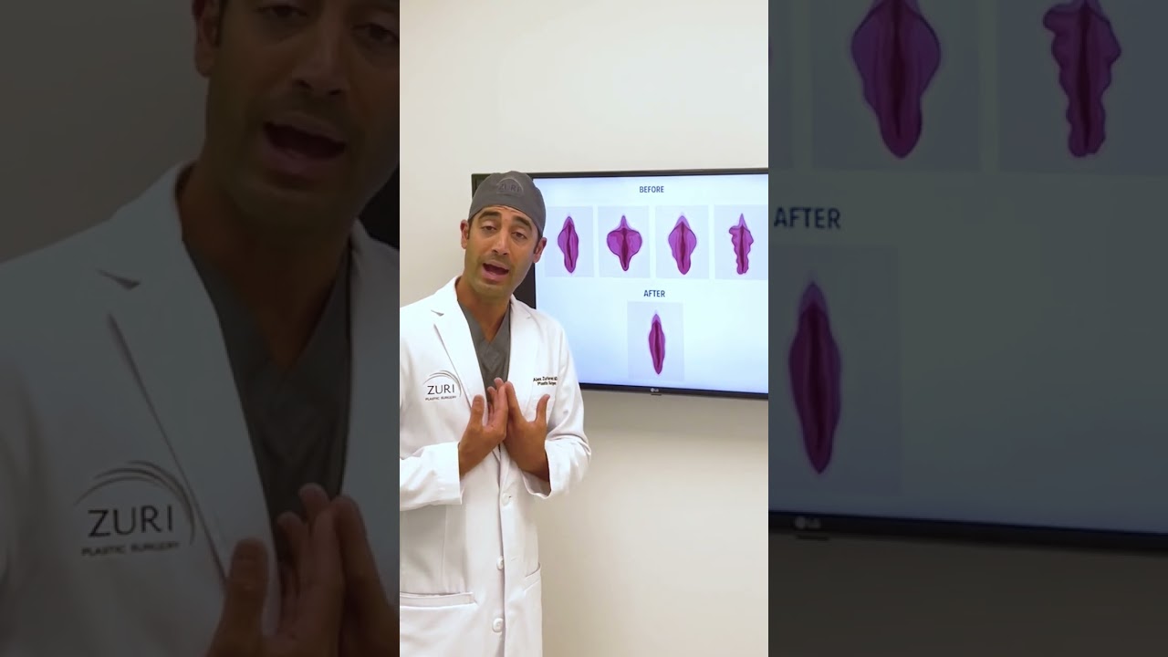 Labiaplasty with Dr. Zuri in Miami | Zuri Plastic Surgery