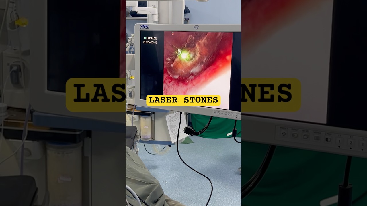 LASER SE STONE PATHRI KA OPERATION KAISE HOTA HAI ? Kidney stones treatment