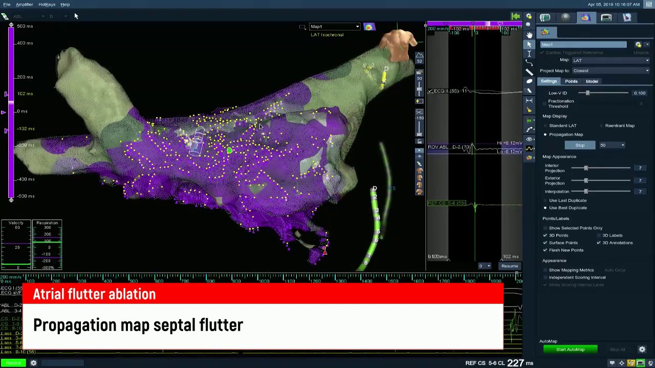 Left atrial flutter ablation, радиочастотная аблация левопредсердного трепетания