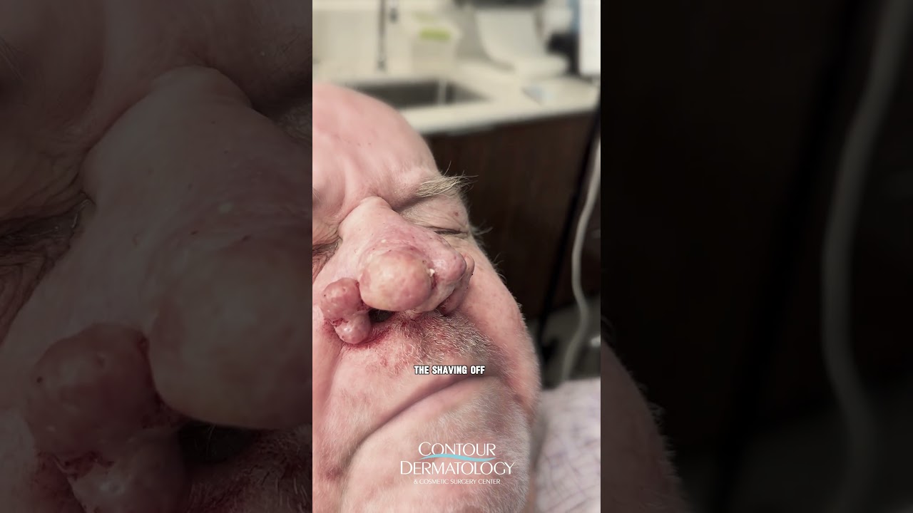 Life Changing Rhinophyma TRANSFORMATION!