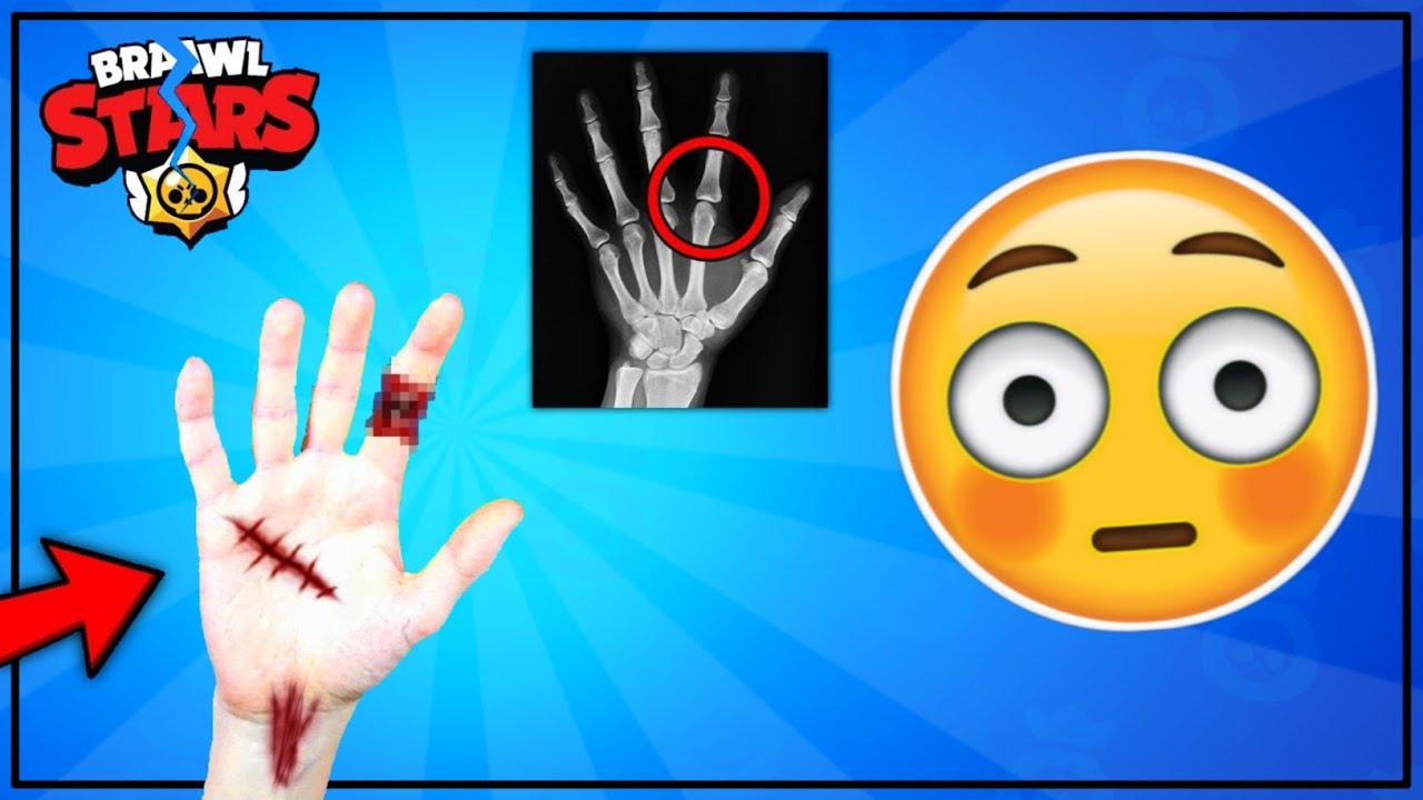 Lik je IZGUBIO RUKU zbog Brawl Starsa... 😳