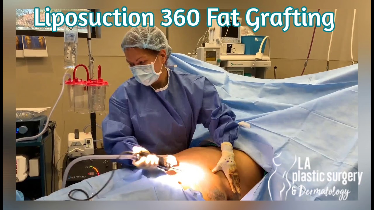 Liposuction 360 #plasticsurgery #liposuction #360lipo