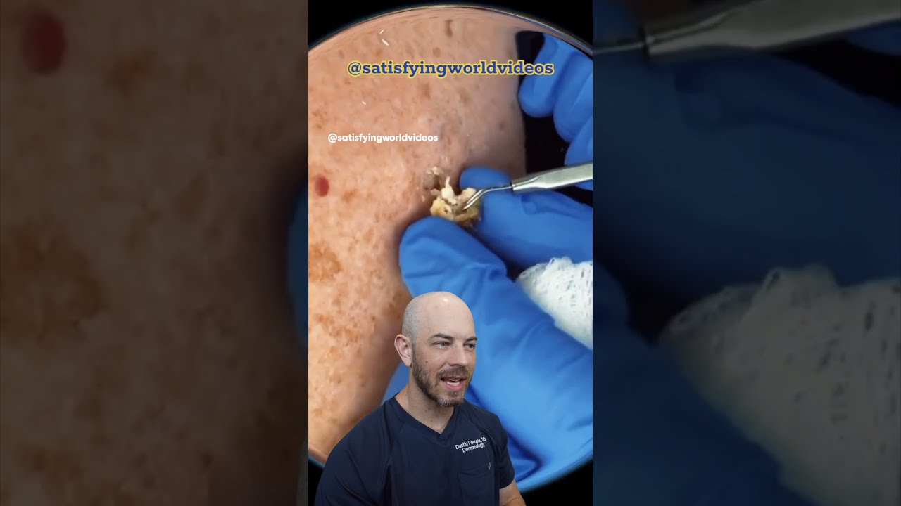 Look out for these juicy pore of Winer extractions! 🩺 (credit: @satisfyingworldvideos on TT)