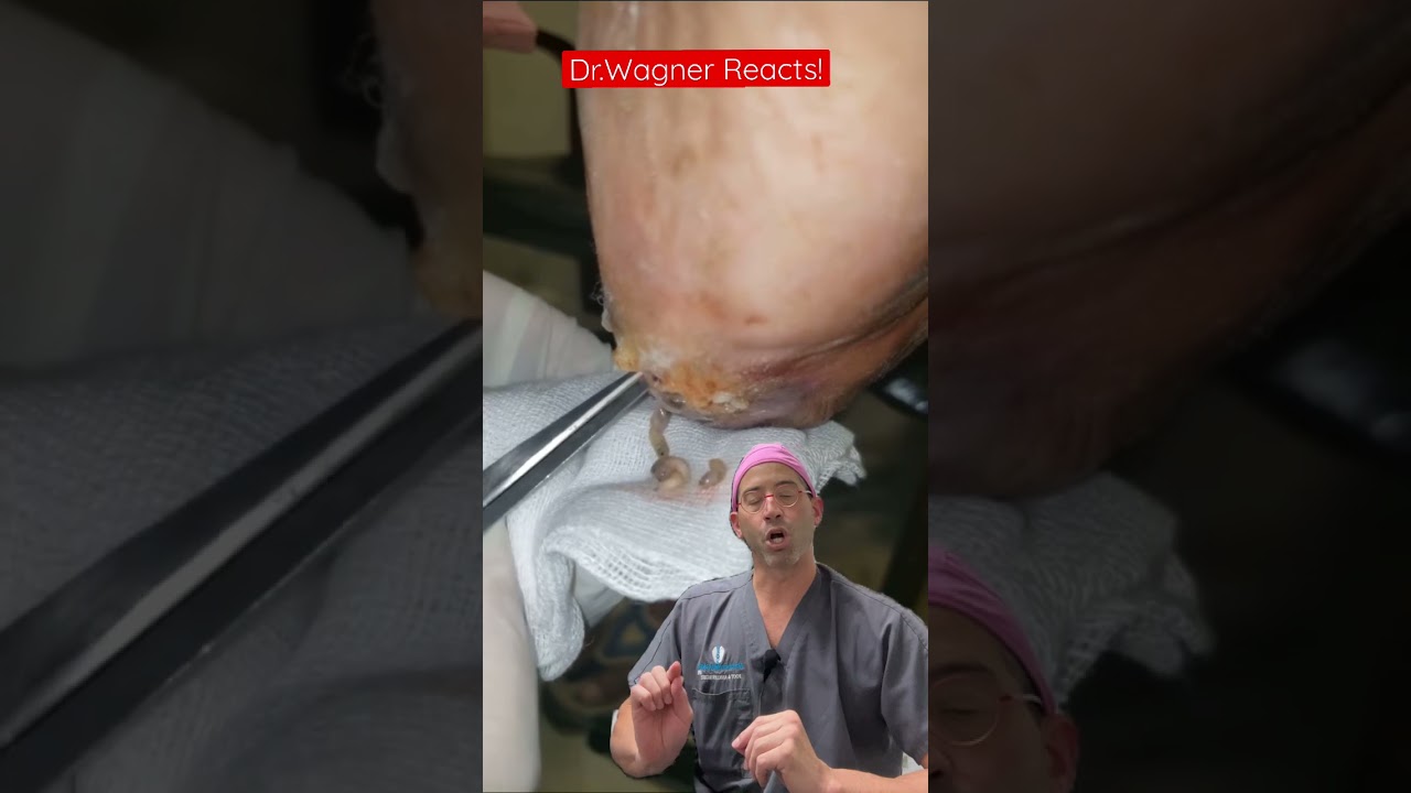 MAGGOT THERAPY 🐛 #shorts #woundcare