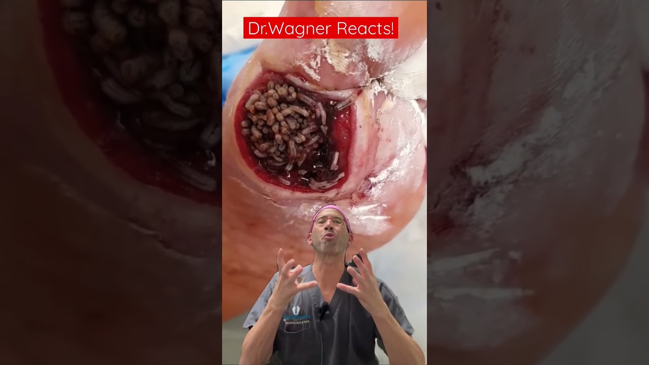 MAGGOT THERAPY: PART 2 🐛#shorts #woundcare