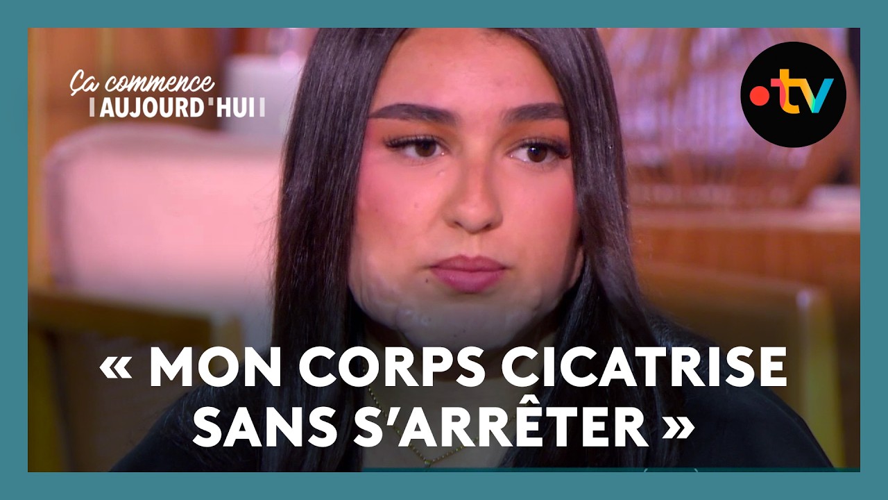Maladie de peau : elles ont réussi à accepter leur différence ! - Ça commence aujourd'hui