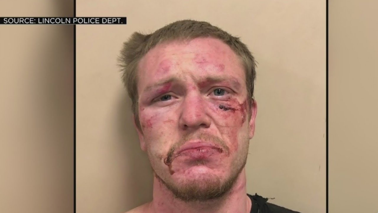 Man Accused Of Biting Another Man On The Face In Lincoln