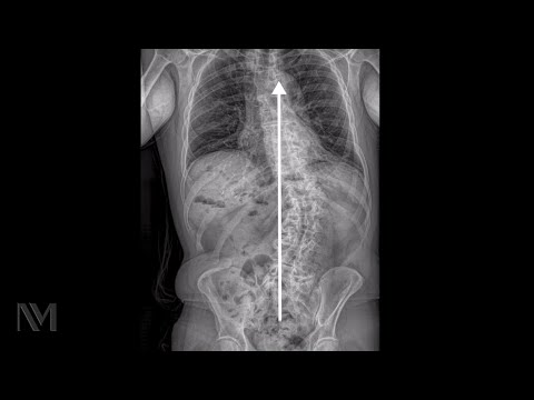 Managing Adult Scoliosis: Symptoms, Diagnosis and Treatment Insights for Primary Care Physicians