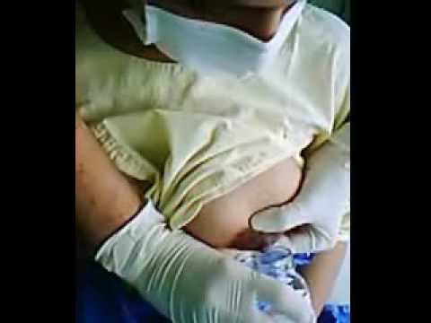 Massagem mamária - ordenha de leite humano -