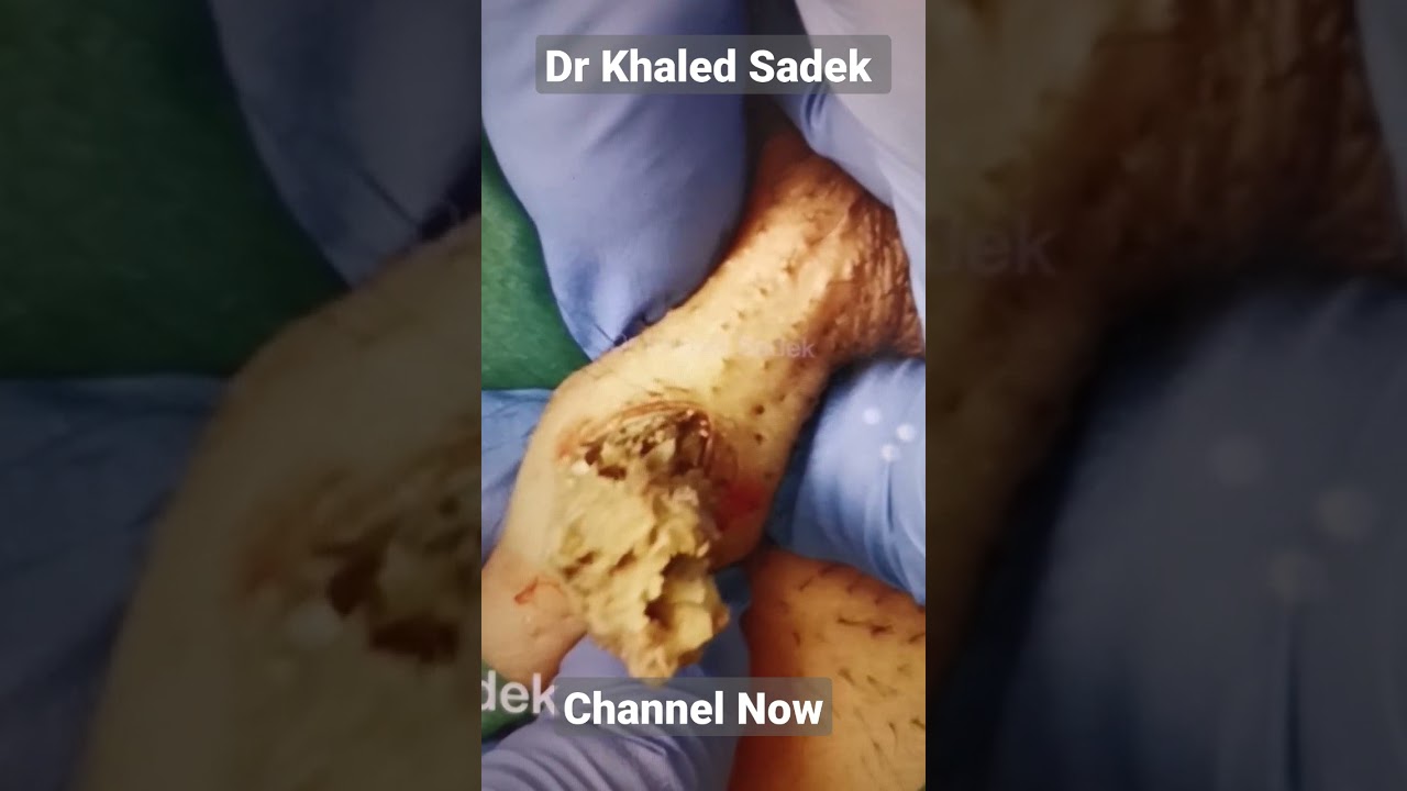 Massive armpit cyst. Dr Khaled Sadek. LipomaCyst.com #shorts