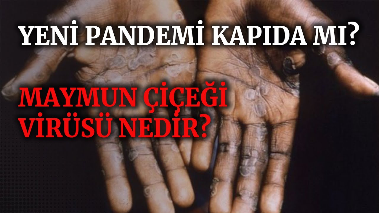 Maymun çiçeği virüsü nedir? Nasıl bulaşır? Belirtileri neler? Tedavisi var mı?