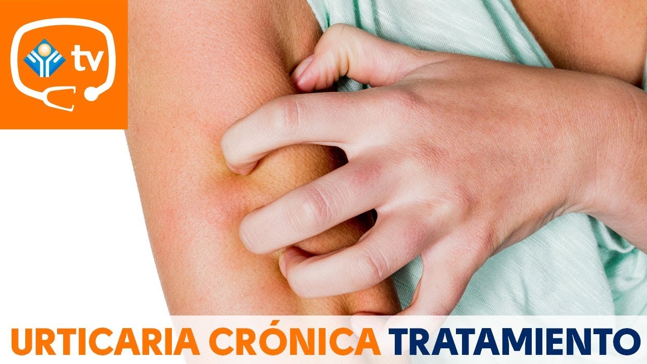 Me muero de picores, ¿hay algún tratamiento eficaz contra la urticaria crónica?