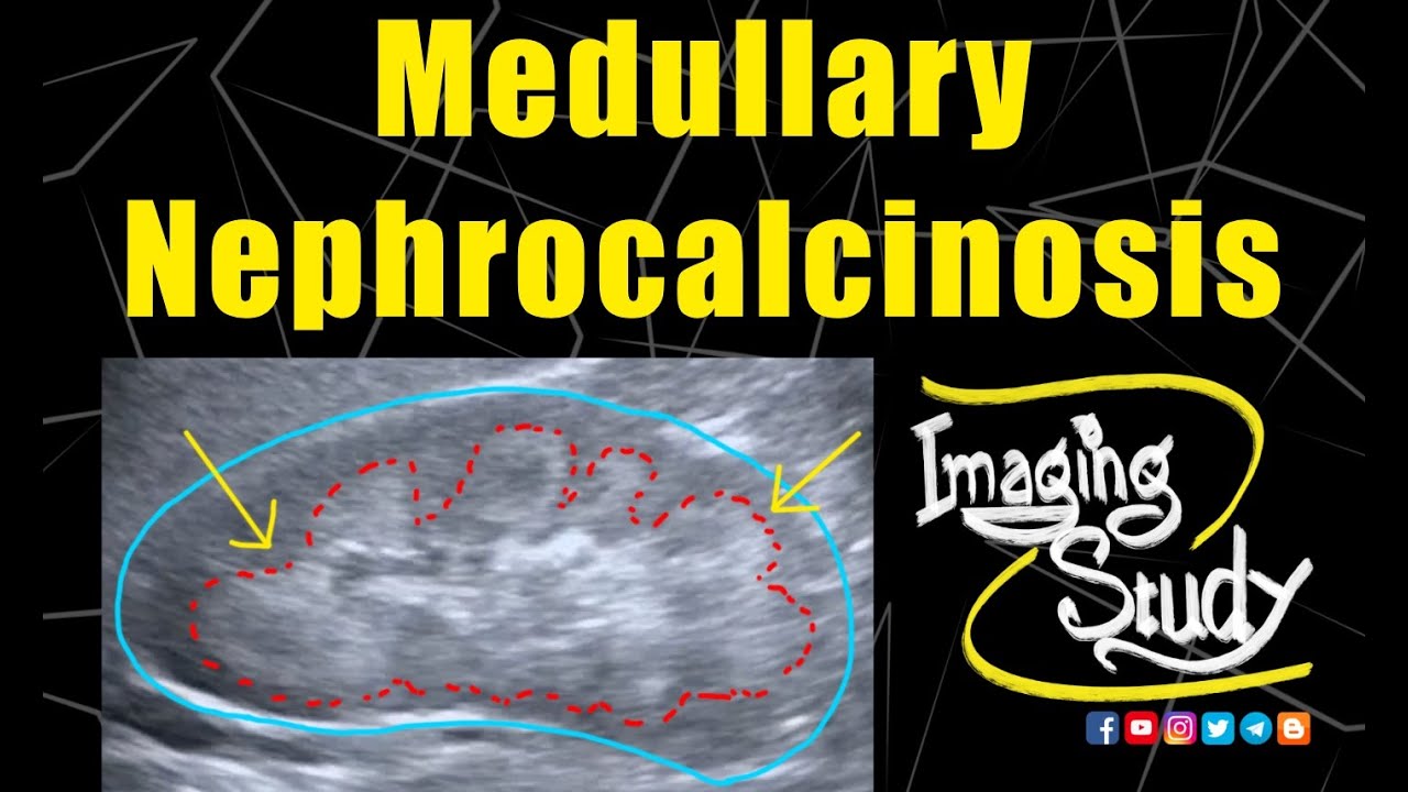 Medullary Nephrocalcinosis || Ultrasound || Case 128