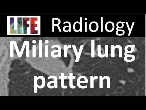 Miliary lung pattern - radiology clinical lecture (tuberculosis, fungal lung infections)
