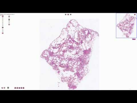 Miliary Tuberculosis - Histopathology