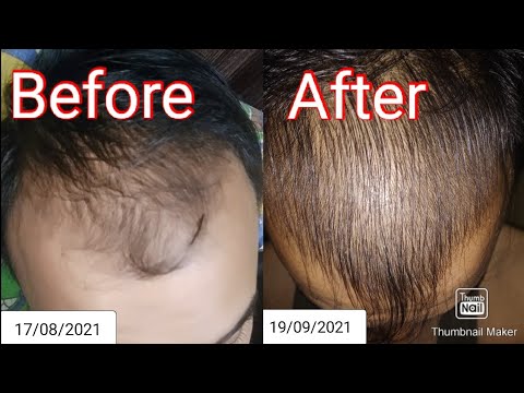 minoxidil 5 % and Derma roller results in 2 months