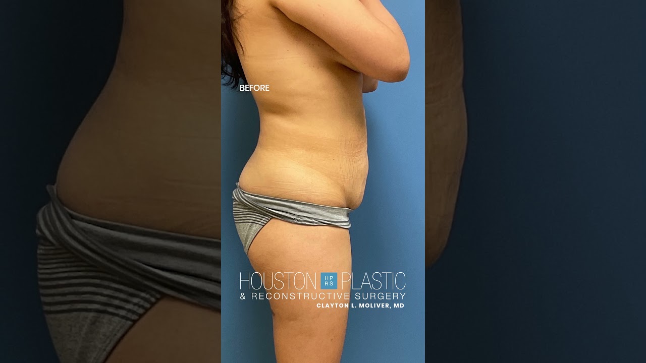 Mommy makeover. #tummytucksurgery #tummytuckbeforeandafter #shorts