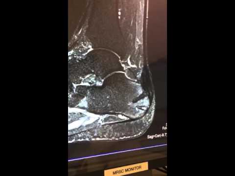 Mri15