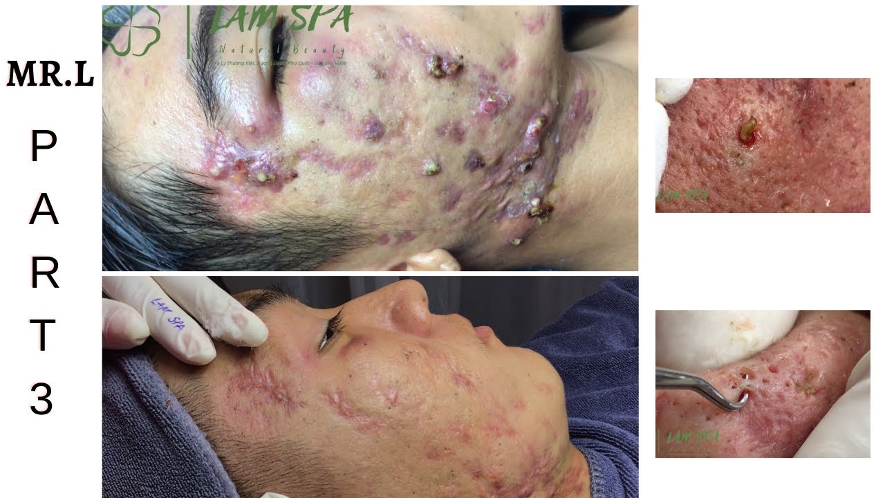 [Mr.L Part 3] Treatment of acne pustules, severe inflammation | Điều trị mụn mủ viêm nặng | LAMSPA