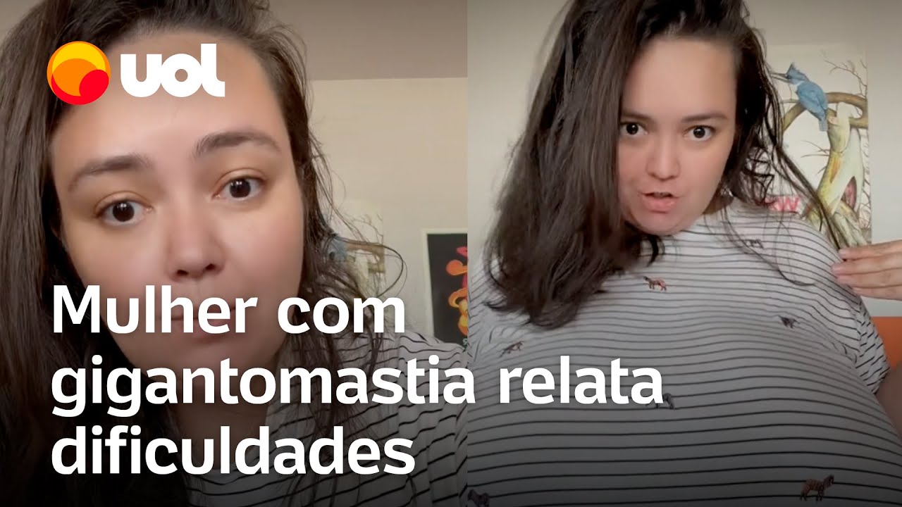 Mulher tem doença dos seios gigantes e conta que tem medo até de cair da escada: ‘Não vejo nada’