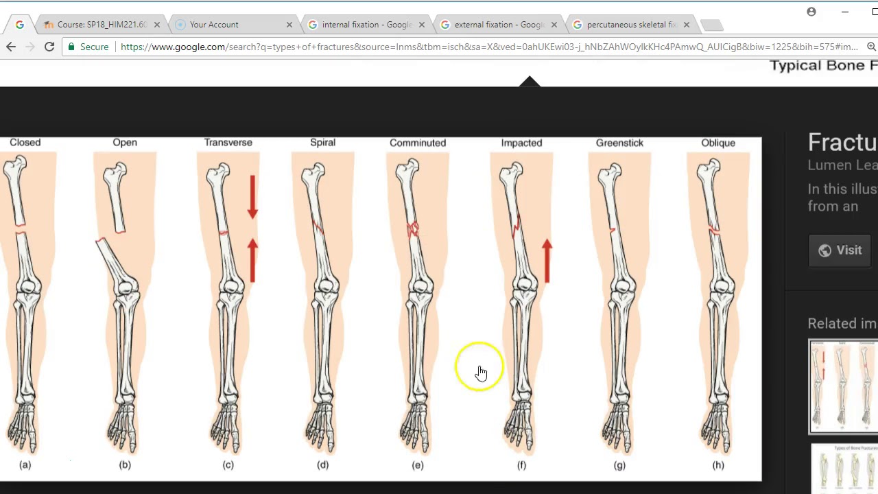 Musculoskeletal Surgery CPT