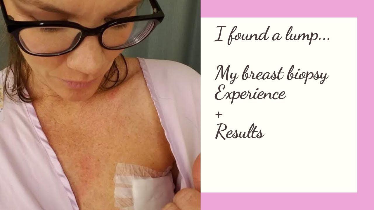 My Breast Lump & Biopsy Experience + Results (Story 1) July 2018