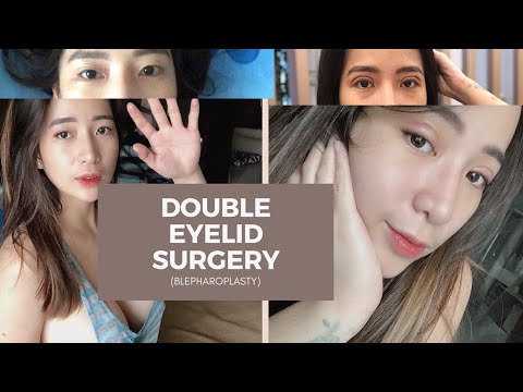 My eyelid surgery journey (BLEPHAROPLASTY) | Irish Tan