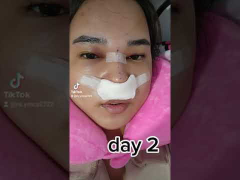 My Rhinoplasty journey🥰.