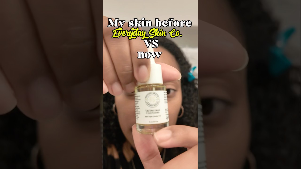 My skin before Everyday Skin Co vs Now #beautycare #clearskin #acnetreatment #darkspots #Bbeauty