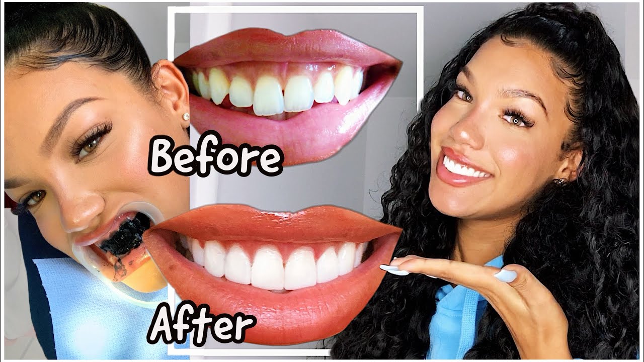 MY TEETH TRANSFORMATION! (Getting Veneers Experience w/ FOOTAGE)