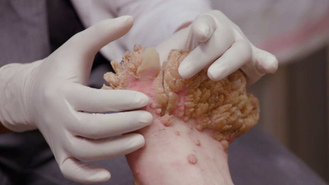 Mysterious Growths Removed From Man’s Feet