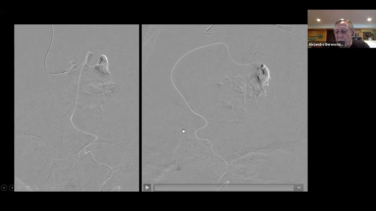 Neuroendovascular Embolizations to Cure Vein of Galen Malformation