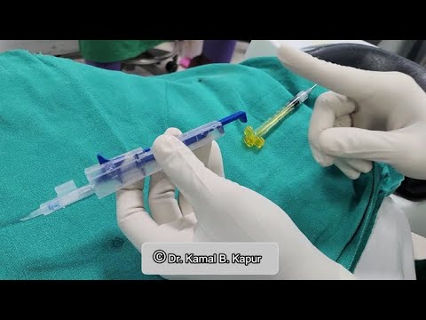 New Eyecryl sert  IOL with Comfort injector system , insertion technique  by Dr. Kamal Kapur