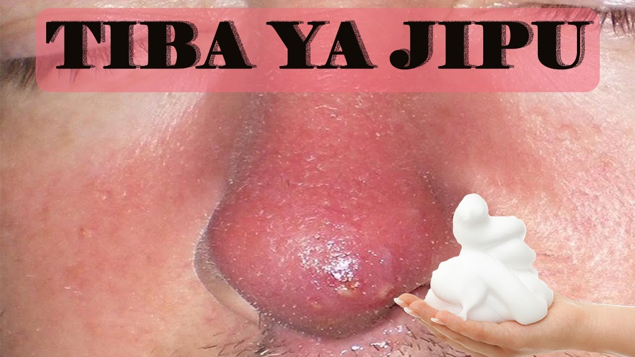 Njia rahisi ya kutibu majipu