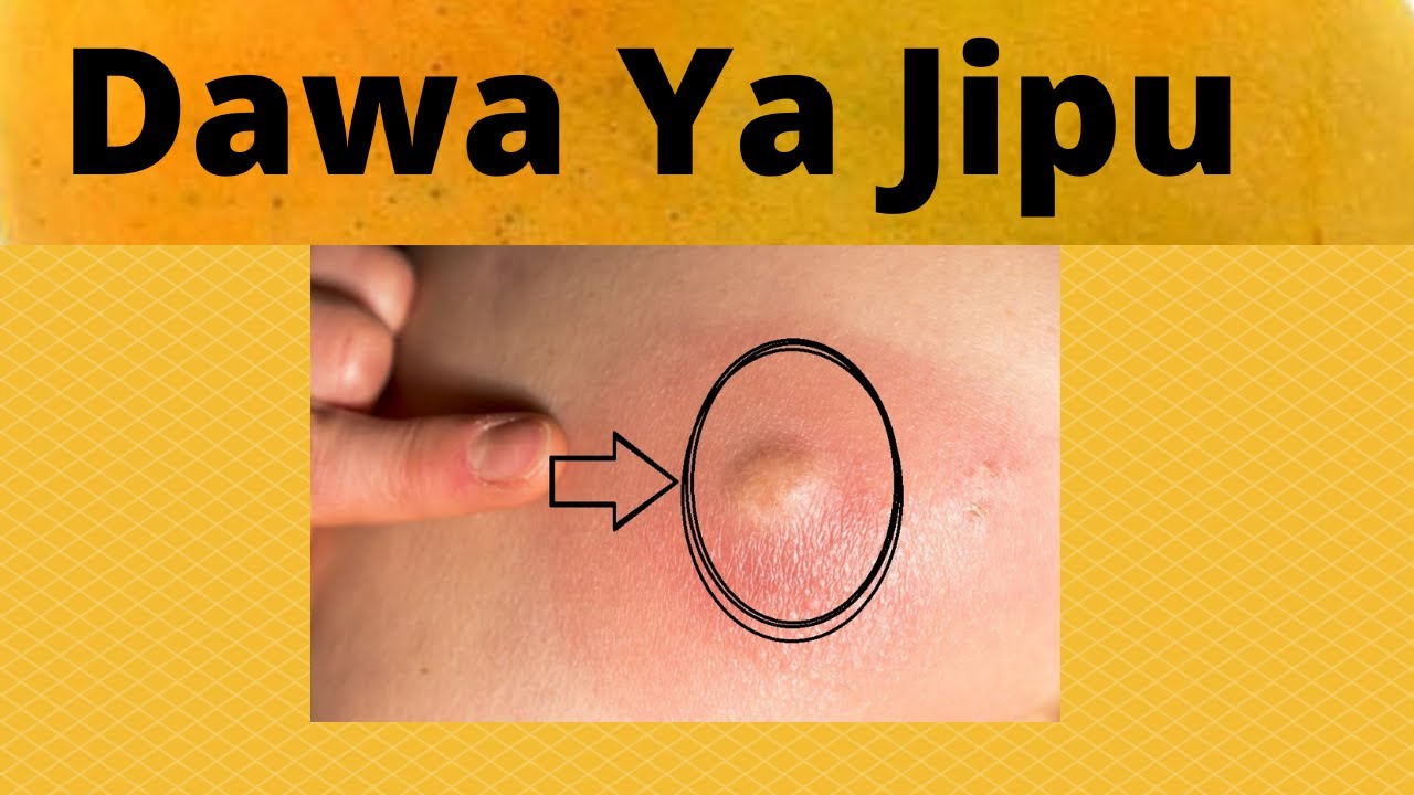 Njia ya Kuondoa Majipu hapo Nyumbani
