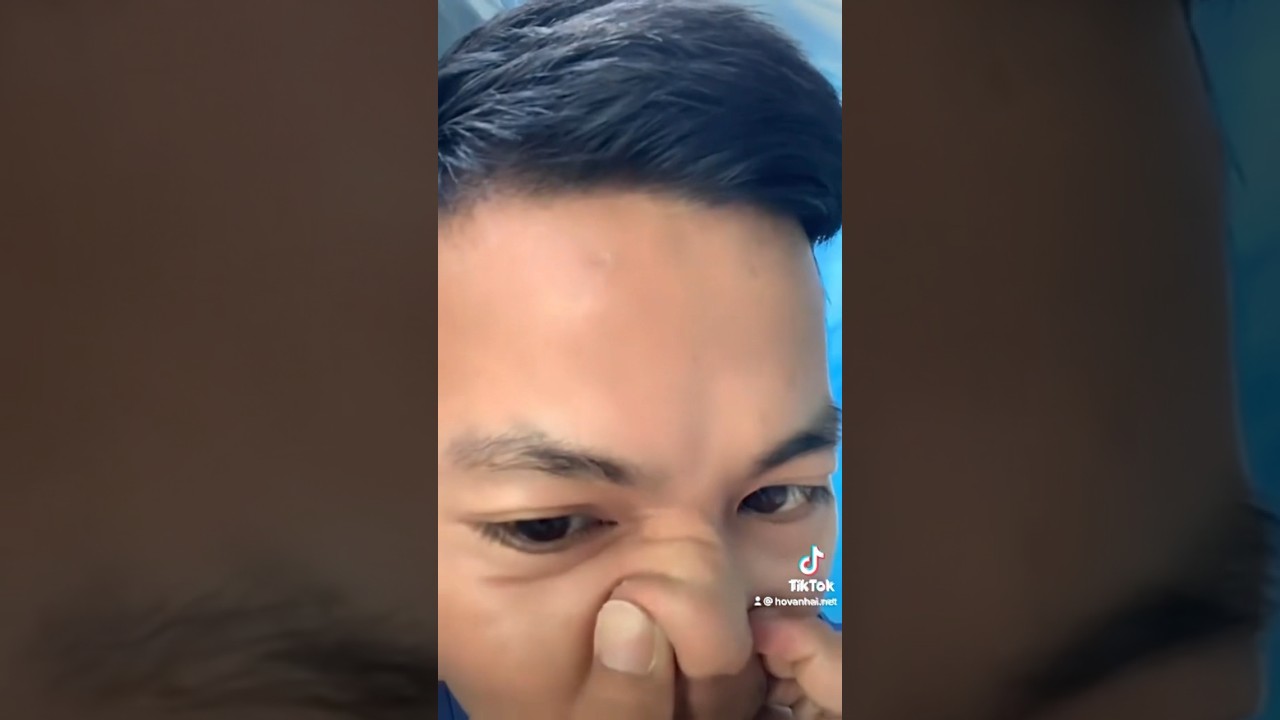 Nose oil check | Did it neatly | Blackheads Free