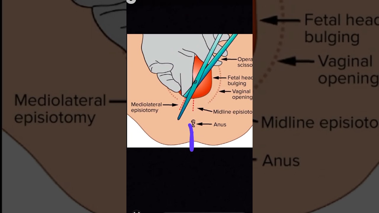 Obstetrics Episiotomy types viva