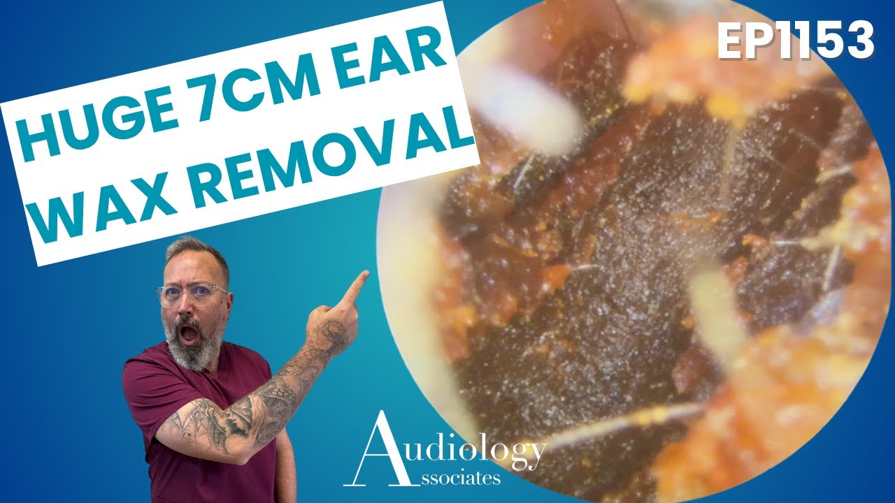 One Of Our Biggest Ear Wax Removals! - EP1153