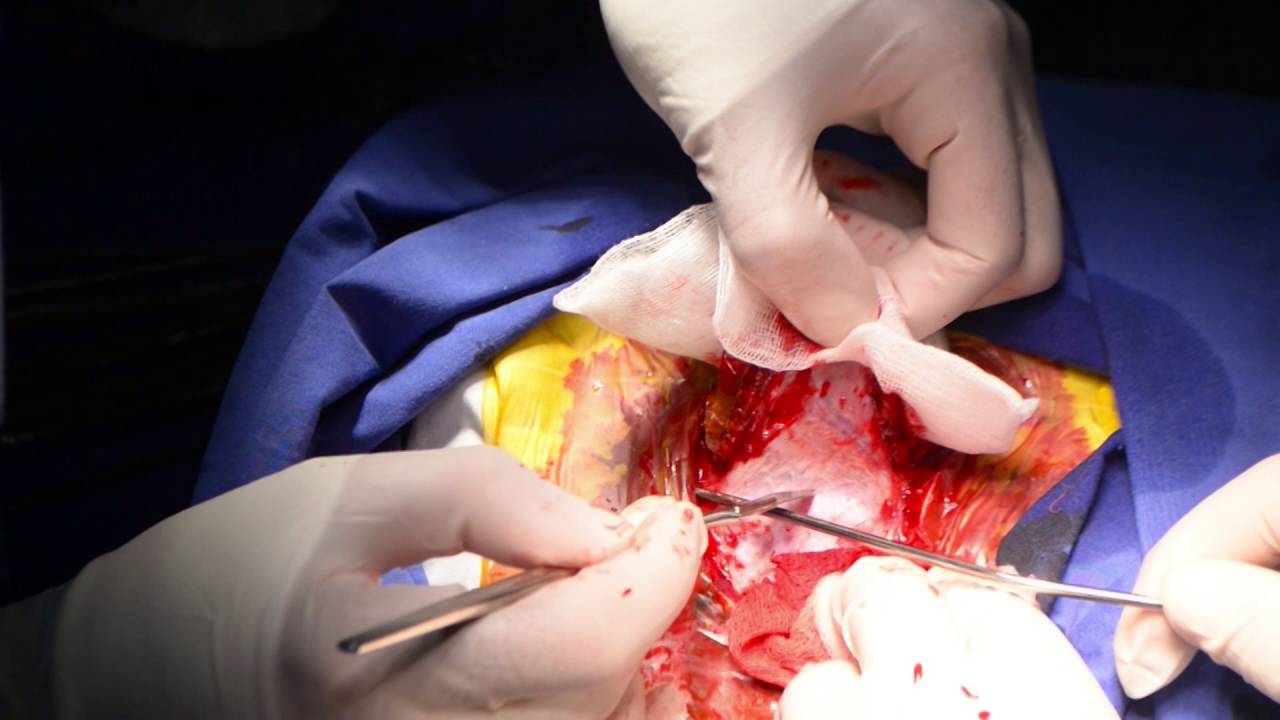 Op.Dr.Tural Rahimli Epilepsiya Əməliyyatı