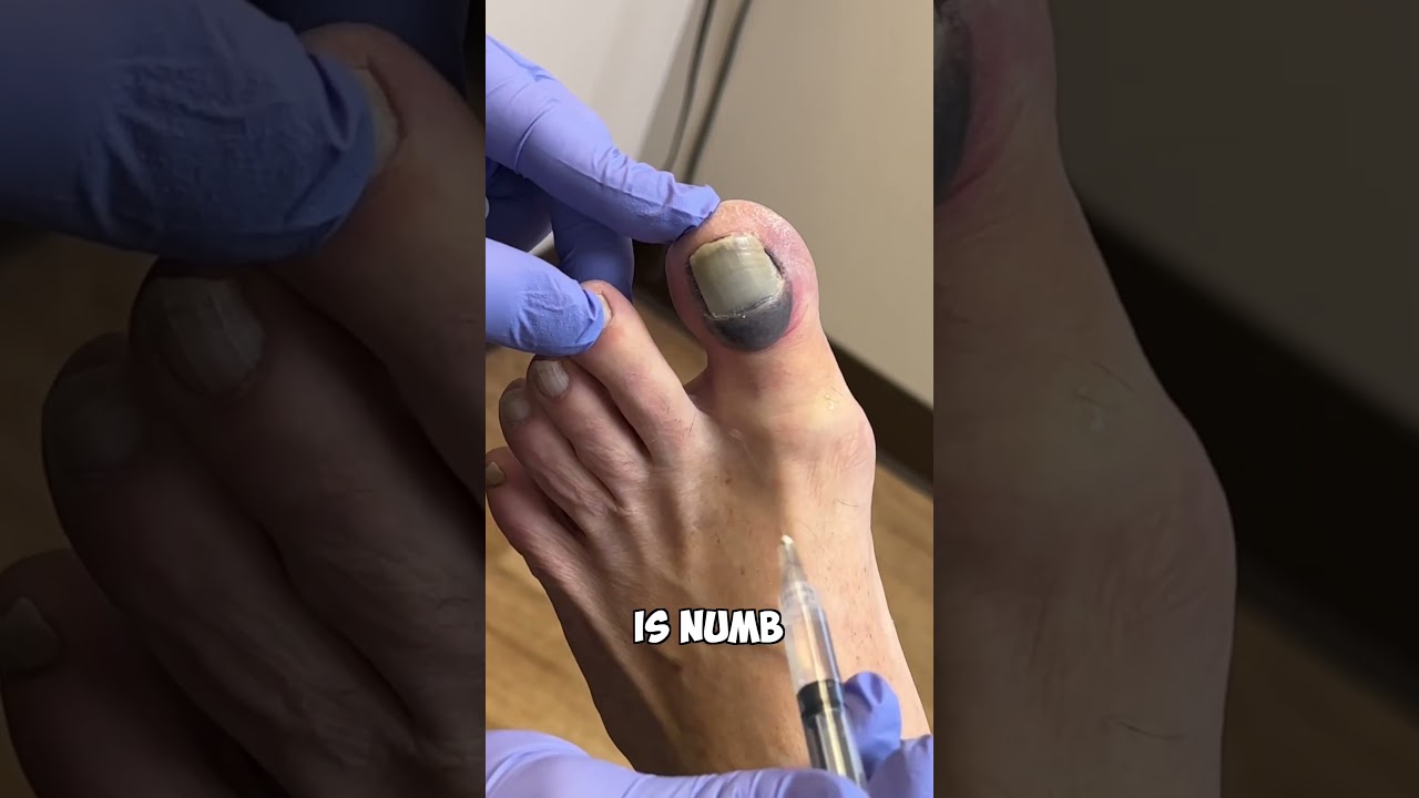 Ouch! Numbing A Toe: A Quick Fix