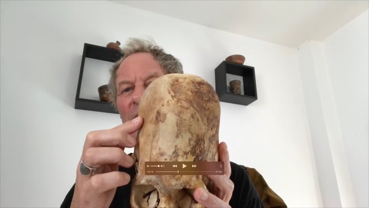 Paracas Elongated Skulls Of Peru: The DNA Results, Morphological Anomalies, And Blood Type Surprises