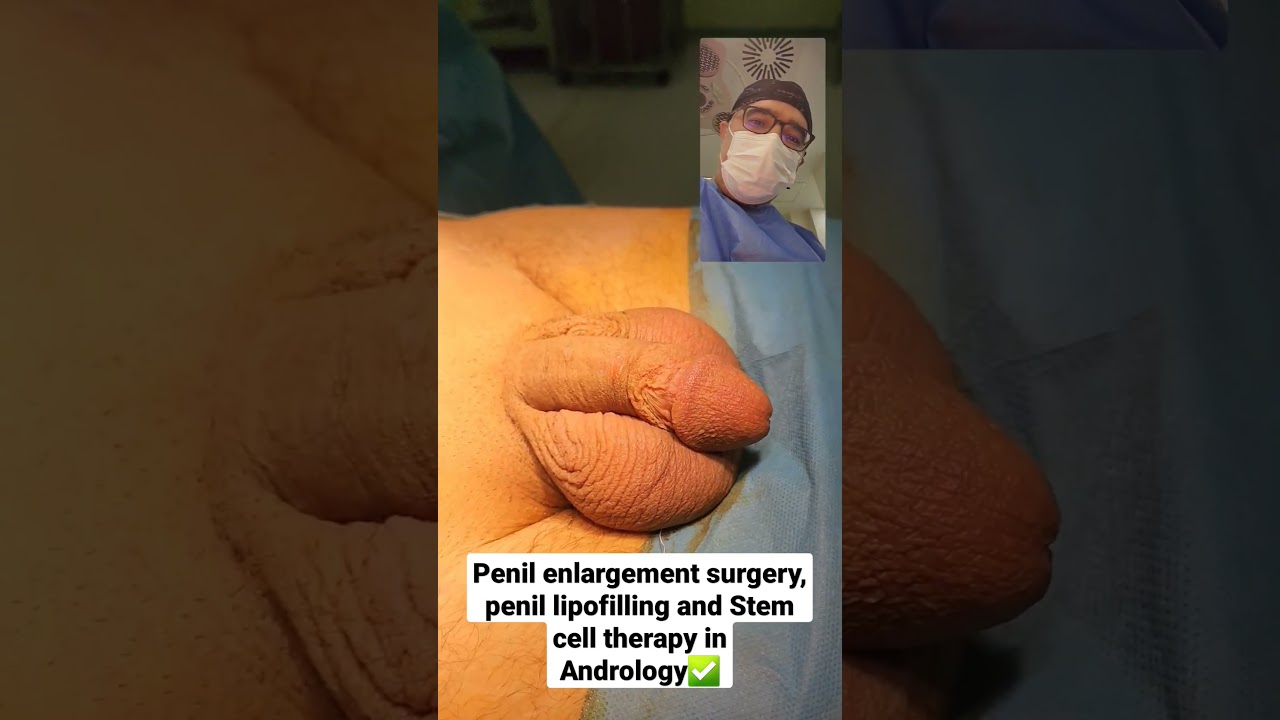 Penil enlargement surgery, Penil lipofilling and Stem cell therapy in Andrology Dr Araz Bayramov
