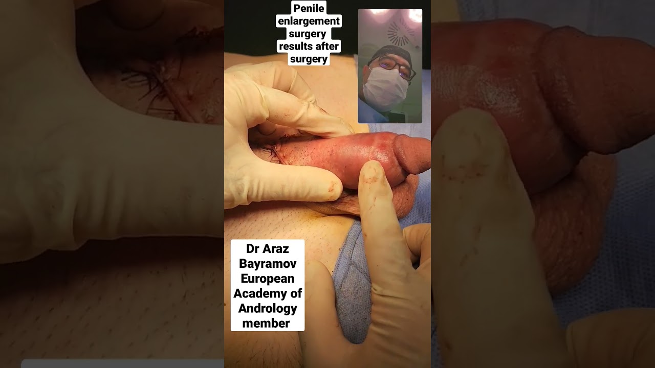 Penile enlargement surgery with excellent results Dr Araz Bayramov www.penilenlargement.com