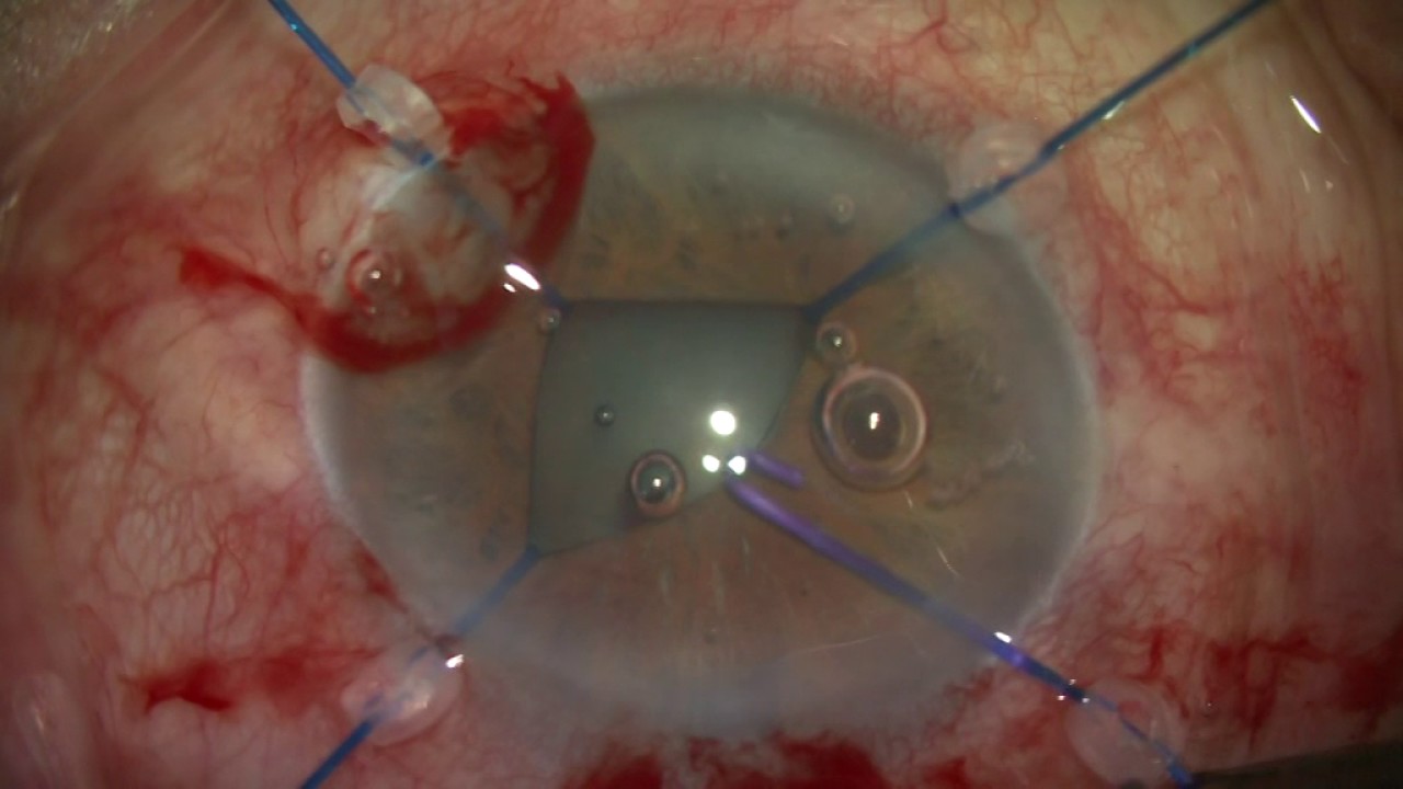 PHACOEMULSIFICATION WITH IRIS HOOKS - Prof Dr Volkan DAYANIR