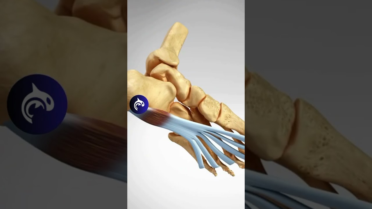 Plantar Fasciitis of the Foot