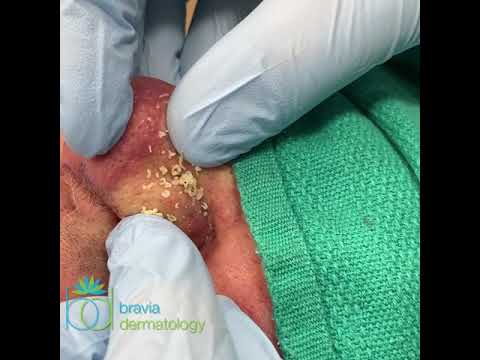 Pore squeeze rosacea congestion of dead skin cells and sebum on nose