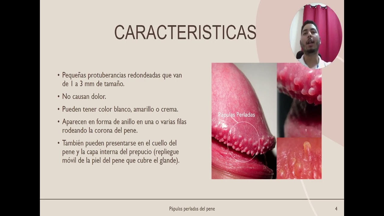 Pápulas perleadas del pene