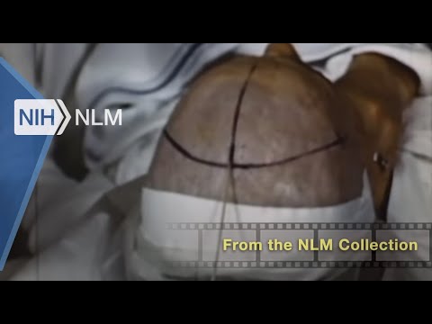 Prefrontal Lobotomy in the Treatment of Mental Disorders (GWU, 1942)