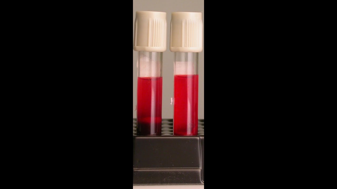 Preventing Hemolysis in the Blood Samples You Draw